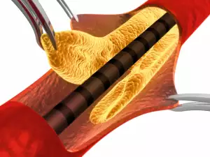 Was ist Cholesterin?
