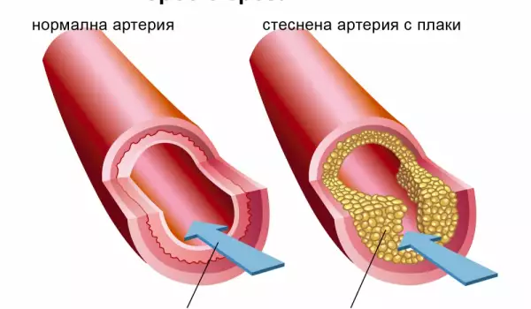 Atherosklerose